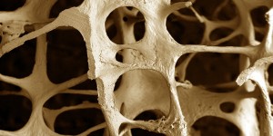 osteoporoza